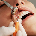 BrightSmile Teeth Whitening Pen