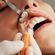 BrightSmile™ Teeth Whitening Pen